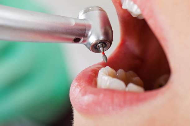 Best Emergency Dental Extractions in Bloomgton, IN